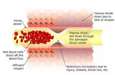 Restricted blood flow (ischemia) causes Hypoxia