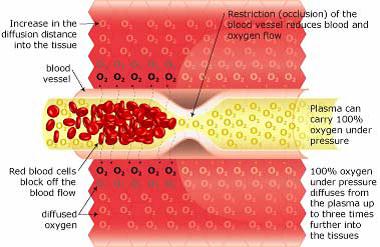 Hyperbaric Oxygenation